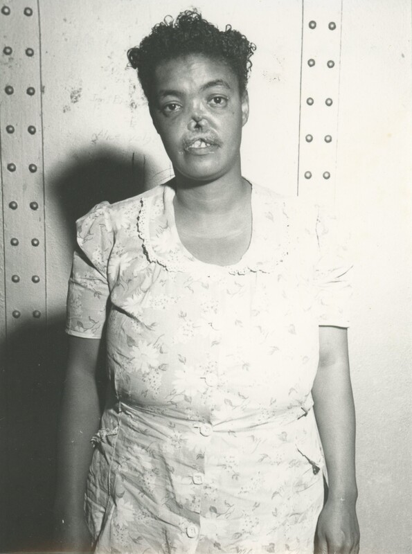 A person with a face disfiguration stood for a mugshot photo.